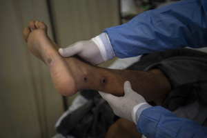 Read more about the article Monkeypox cases top 70,000: WHO